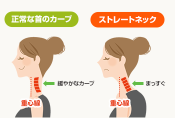 ストレートネック