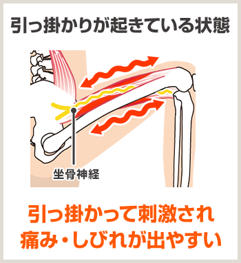 引っ掛かりが起きている状態